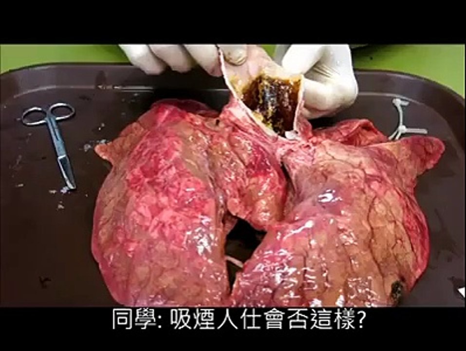 How Smoking Kill Your Lung