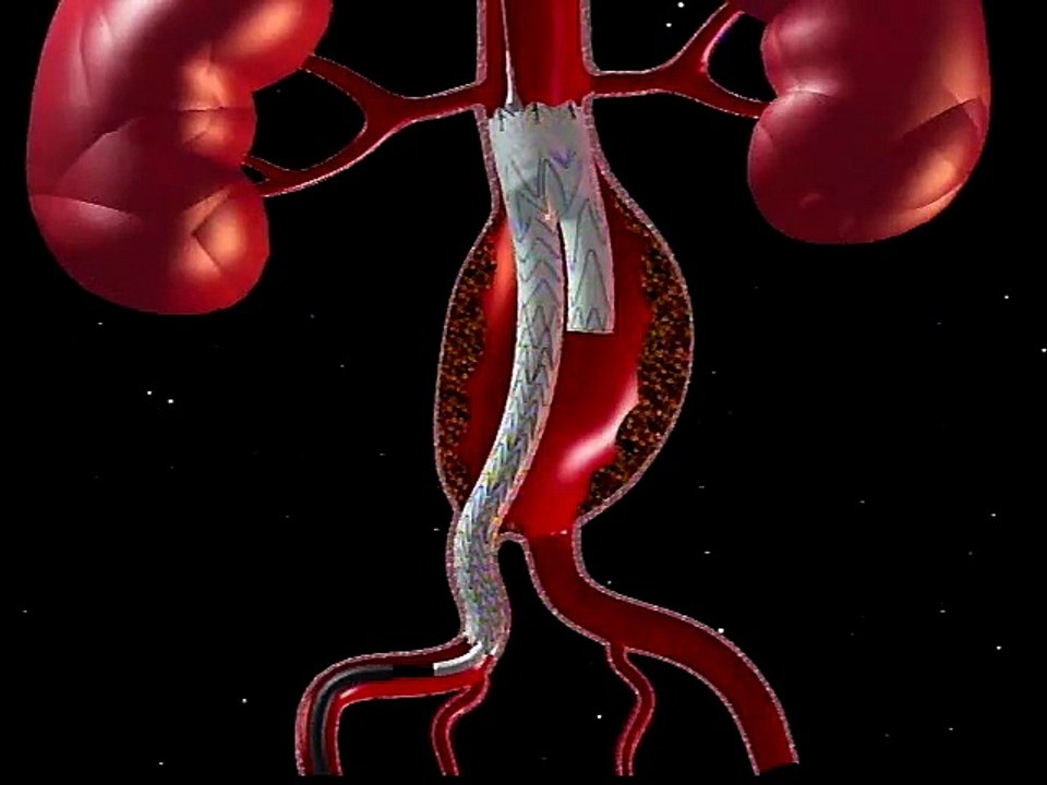 Abdominal Aortic Aneurysm Graft Repair