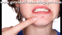 How to get rid of acne