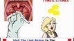 Banish Tonsil Stones Review & Bonus WATCH FIRST Bonus + Discount