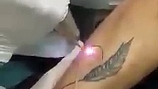 This is How a Tattoo can be removed now