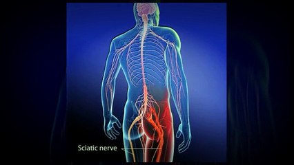 Sciatica treatment that really works