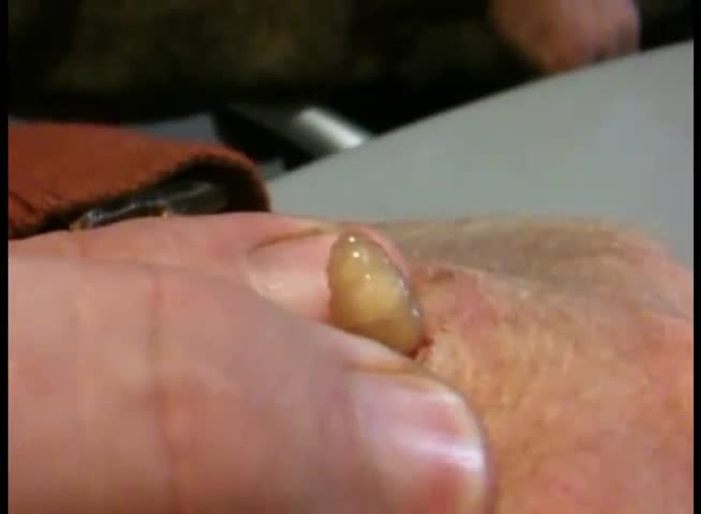 Il laisse grandir une larve de mouche dans sa main