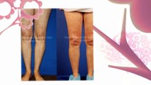 Laser Vein Treatment Scottsdale | Ciao Bella Vein Clinic (480) 686-8121