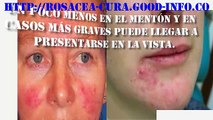 Remedios Caseros Para La Rosacea, Enfermedad De La Piel Rosacea, Rosacea Cura