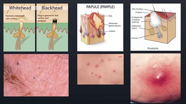 Learn How To Treat Moderate Acne