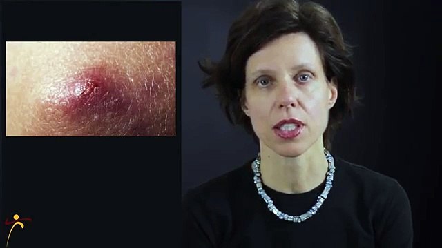 Find Out What Type Of Acne You Have