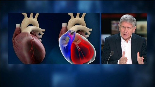 Cœur artificiel Carmat: le 2nd implanté a repris une vie normale explique Alain Ducardonnet