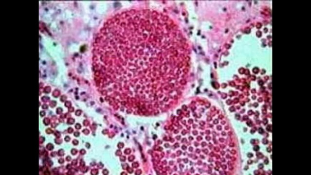 Trieu chung chuan doan dieu tri ung thu te bao mau