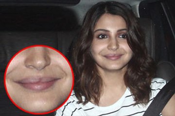 Lip surgery gone wrong for Anushka, AGAIN?