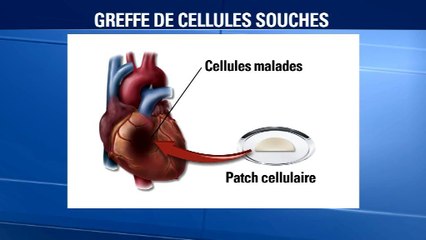 Le coeur d'une patiente réparé avec un patch de cellules cardiaques dérivées de cellules souches