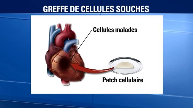 Le coeur d'une patiente réparé avec un patch de cellules cardiaques dérivées de cellules souches