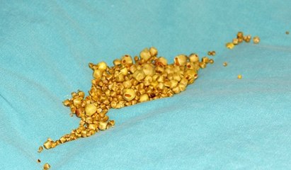Safra kesesinden 704 taş çıktı