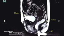 Amazing MRI scan video captures couple having sex