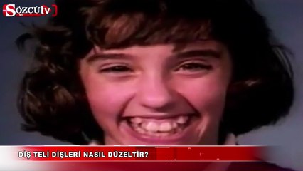 Diş teli dişleri nasıl düzeltir?