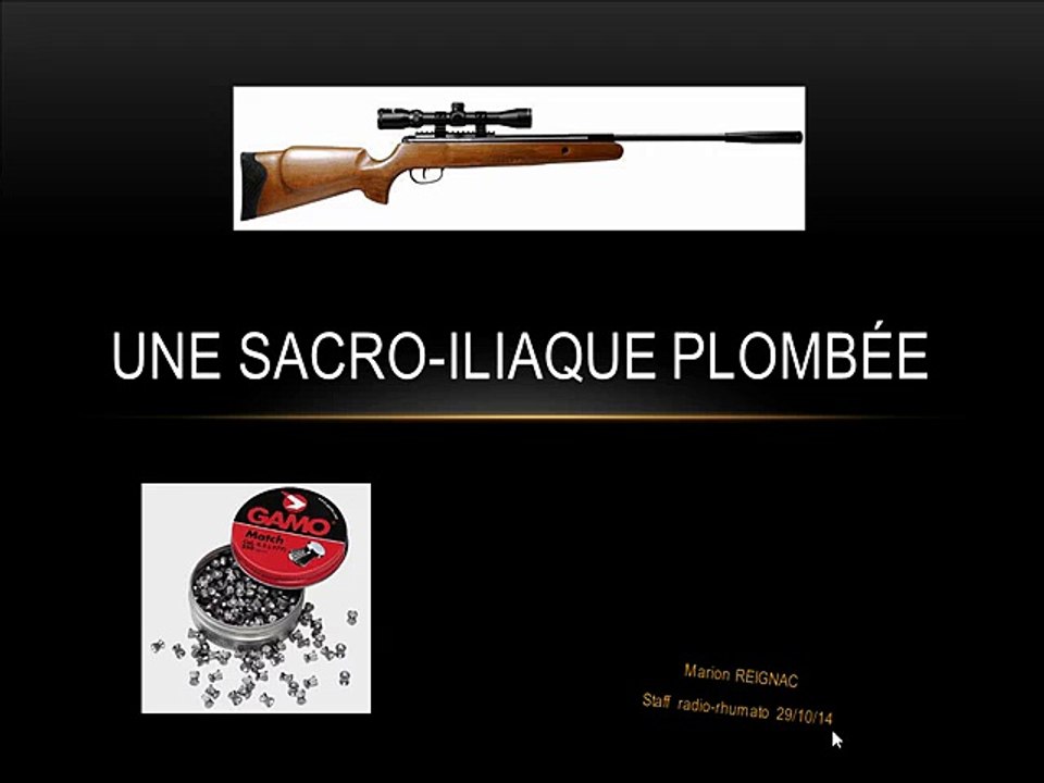 Sacro iliaque