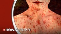 Measles Outbreak Traced to California Disneyland Resorts Leaves 70 Infected