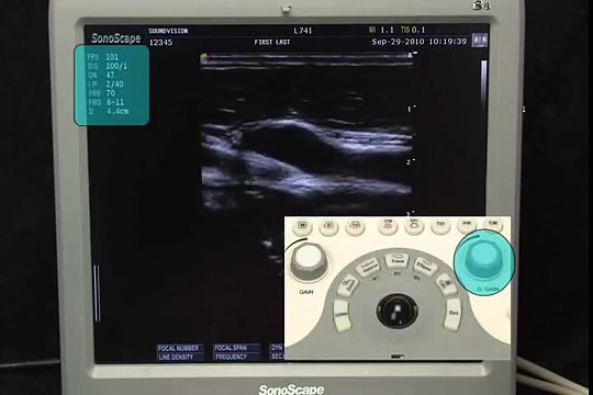 Best Color Doppler Ultrasound Scanner SonoScape S8 / System Controls