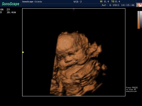 Sonoscape S8 Color Doppler Ultrasound / 4D Real Time Baby