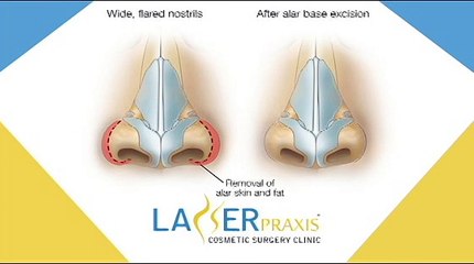 What is Rhinoplasty? Rhinoplasty Clinic in Lahore - Pakistan