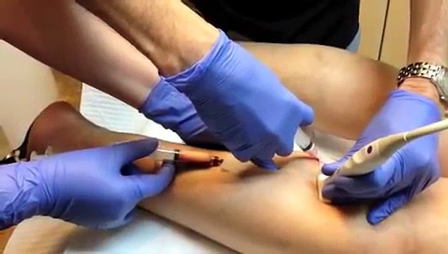 Dr. Khalil Fattahi Presents His Latest Method Of Varicose Veins Foam Washout Sclerotherapy