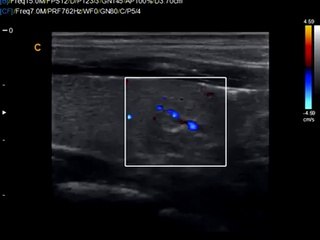 Chison Q9 Color Doppler Sonogram of Thyroid