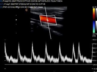 Carotid Triplex Chison Q9