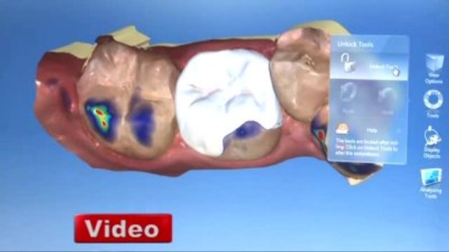Dijital Diş Hekimliği ile Kaplama ve Dolgu Tek Seansta Hastaya Teslim Ediliyor