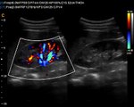 Kidney Video with Chison Q9 Color Doppler Ultrasound