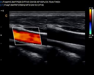 Chison Q9 Carotid Dulpex-Color doppler