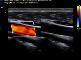 Chison Q9 Carotid Dulpex-Color doppler
