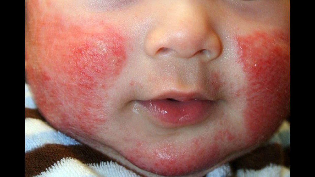 Defeat Eczema Today