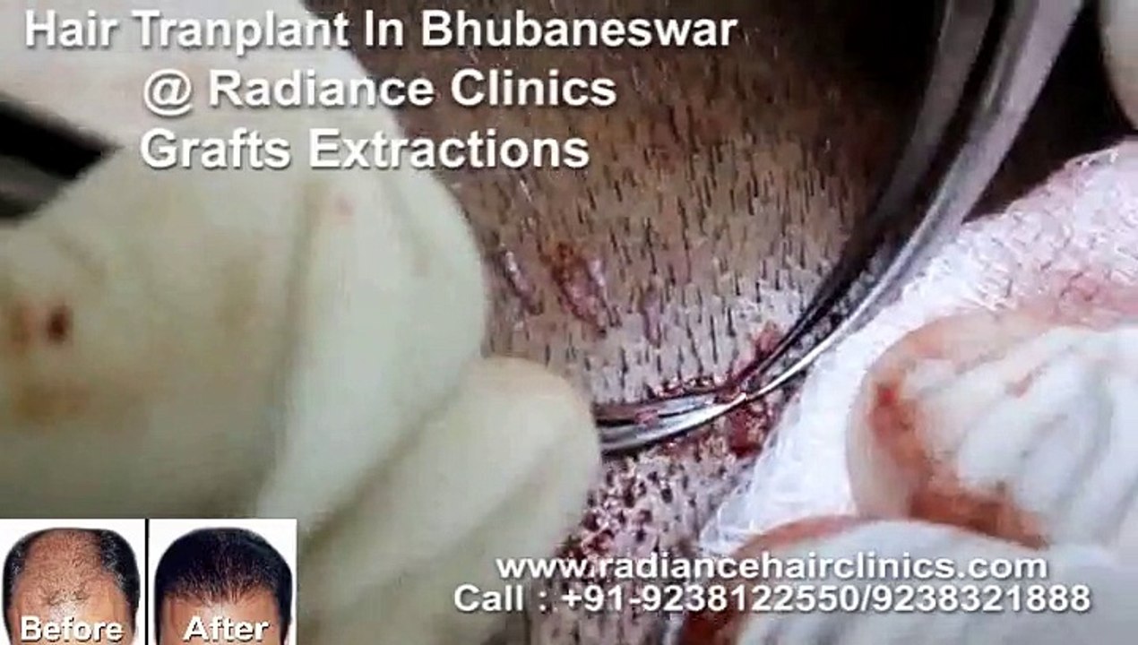 Hair Transplant Clinic Odisha