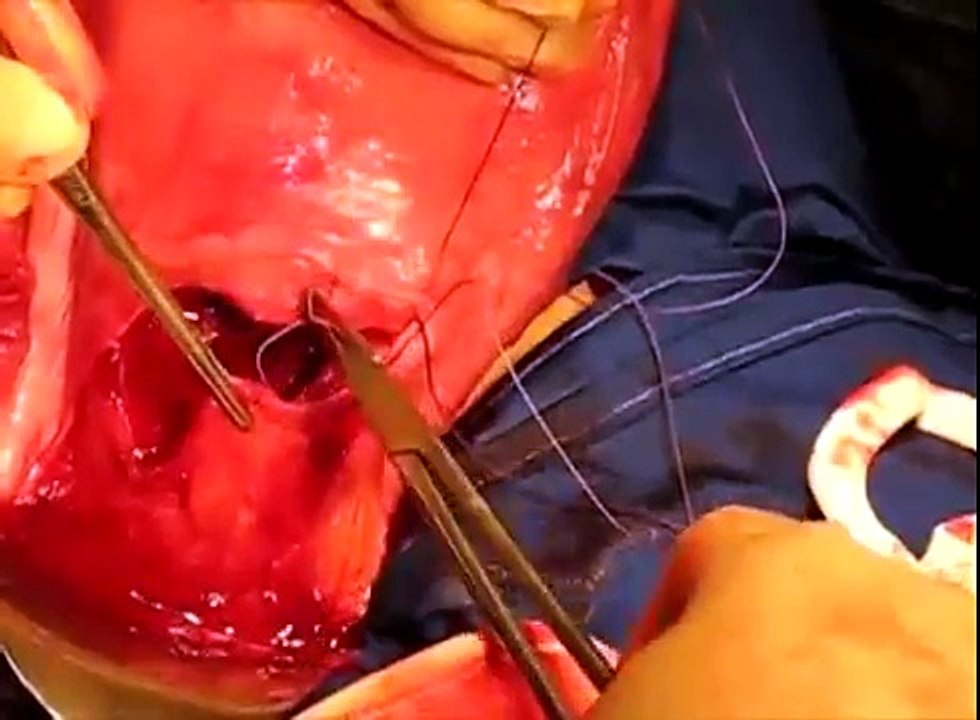 Closure of Uterine Incision in Cesarean Section with TURAN TECHNIQUE