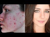 How To Cover Acne & Scars (IF You Want To) - Easy Makeup Transformation Routine