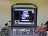 Ultra Compact Ultra Light Chison ECO 1 Ultrasound / Introduction To Easy Diagnosis