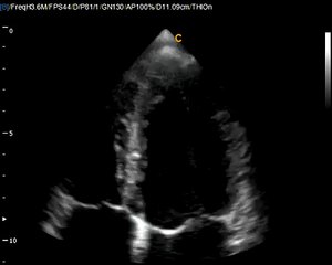 Chison Ultrasound Q Series Image Cardiac Application / Using Phased Array Probe