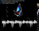 Chison Q9 Ultrasound / Qbit Cardiac Continuos Wave Image Video