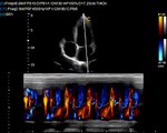 Qbit Cardiac Sonography / Chison Q9 / Phased Array Probe