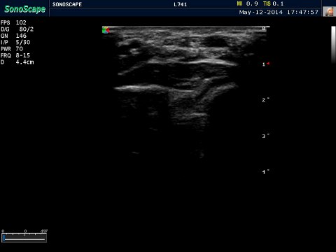 Image of the median nerve for carpal tunnel syndrome Sonoscape S8