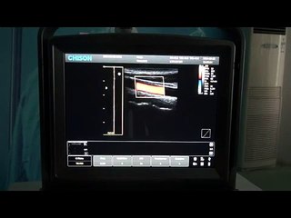 Chison ECO5 Ultrasound Demonstration %7C Vascular%2C Liver and Kidney Application