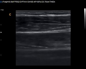 How to find Median Nerve - Chison Q9 Median Nerve Short Video
