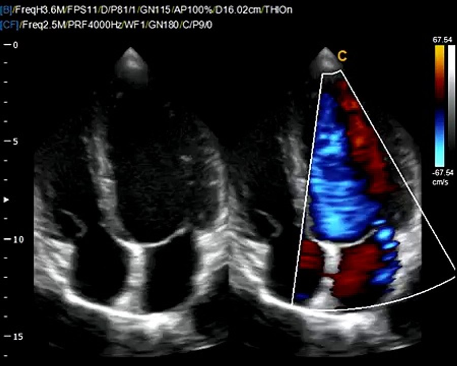 Chison Imaging Q9 Cardiac BBC Ultrasound Image-Recomemned fro eco cardiography