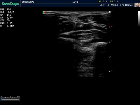 Sonoscape S8 Video of the Median Nerve for Carpal Tunnel Syndrome