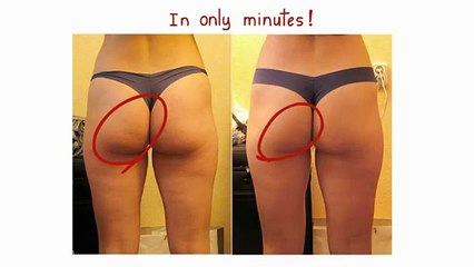 Treatment for cellulitis at home _How to Get Rid of Cellulite on Thighs Naturally1