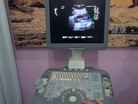 Chison i7 Color Doppler ultrasound trolley model operation