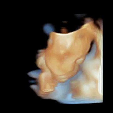 Chison Q5 Color Doppler Ultrasound / 4D Depth View Image Using Volumetric Probe
