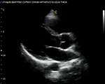 Q9 By Chison Imaging short clip of Cardiac LV Ultrasound