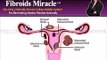 Uterine Fibroids Treatment Cure Fibroids With Natural Remedies