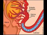 Fibroids Miracle Review fibroids symptoms